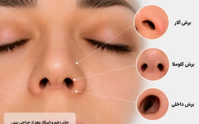 جای زخم و اسکار بعد از جراحی بینی