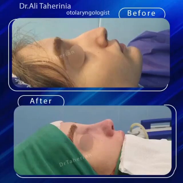 نمونه-کار-جراحى- زيبايى-بينى-دكتر- -على-طاهری-نیا