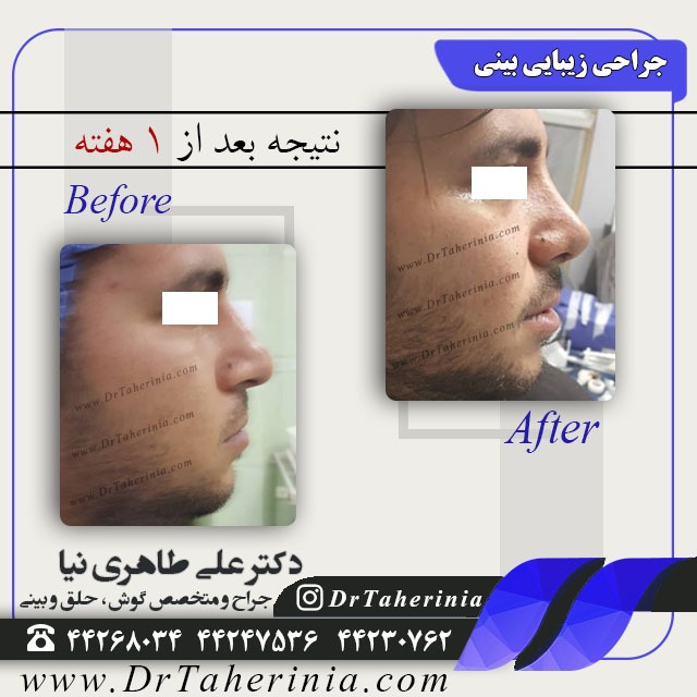 جراحی زیبایی بینی - رضایت بعد از یک هفته
