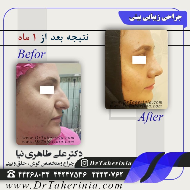 جراحی زیبایی بینی بعد از یک ماه