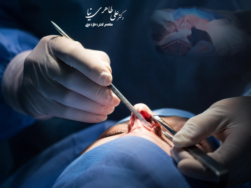 سوهان کشیدن در جراحی بینی