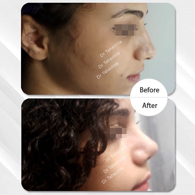 نمونه جراحی زیبایی بینی