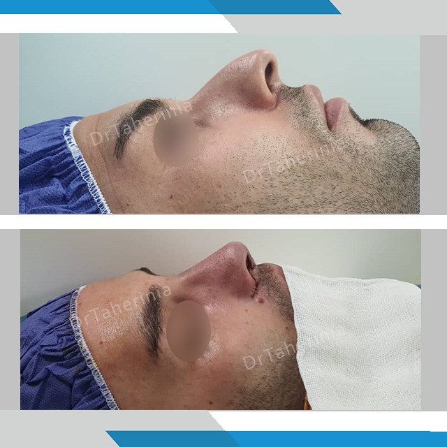 جراحی بینی مردانه - قبل و بعد