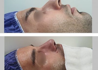 جراحی بینی مردانه - قبل و بعد