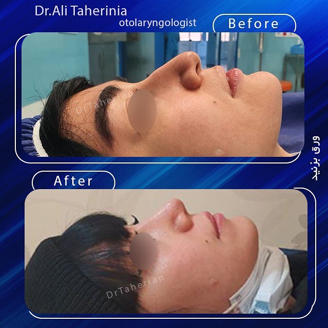 تصویر از عمل بینی دکتر طاهری نیا