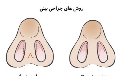تفاوت جراحی بینی باز با بسته چیست؟