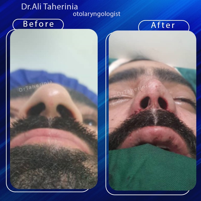 عوارض-عمل-بینی-نیمه-فانتزی