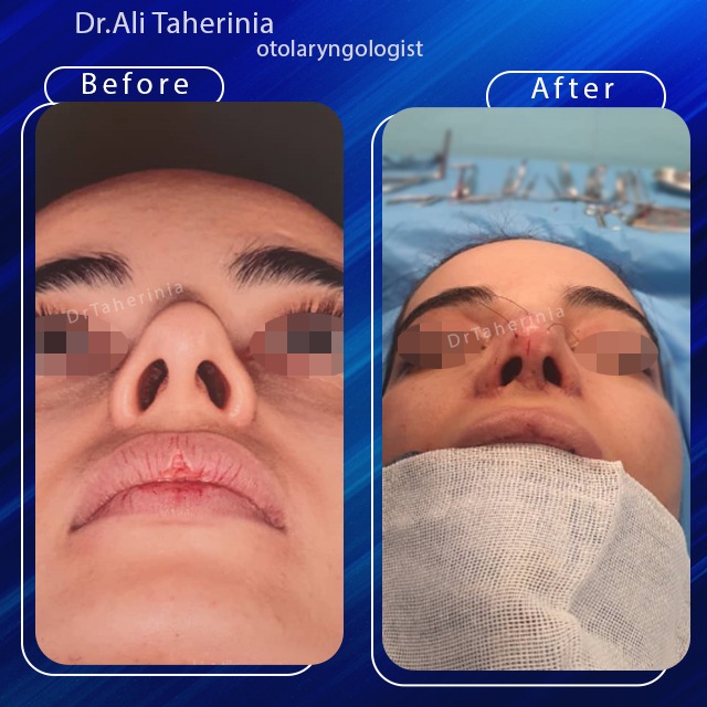 هزینه-جراحی-بینی-نیمه-فانتزی