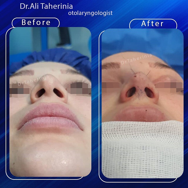 هم اندازه شدن سوراخ های بینی در سپتورینوپلاستی