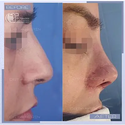 جراحی-بینی-ترمیمی