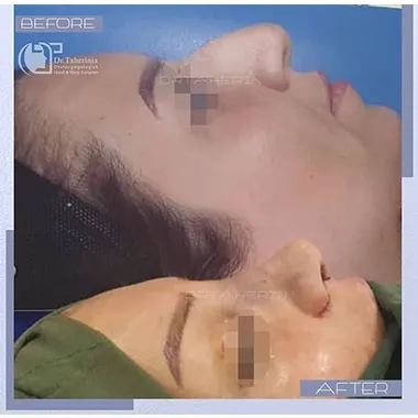 هزینه جراحی زیبایی بینی