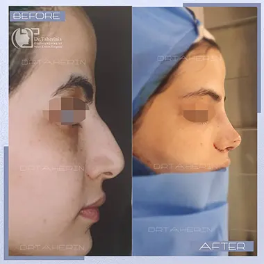 بهترین جراح بینی استخوانی تهران