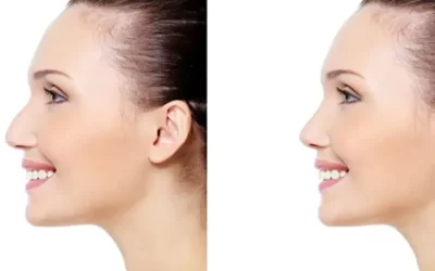 جراحی بینی عقابی | مزایا، هزینه، مراقبت ها + فیلم و عکس