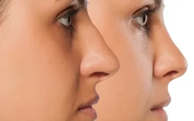 جراحی بینی گوشتی زنانه + نمونه کار و فیلم های دیدنی