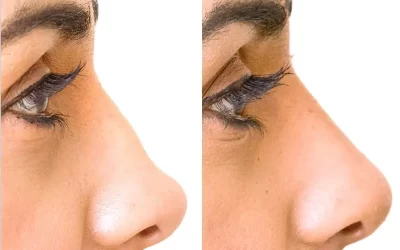 هزینه جراحی بینی گوشتی در سال 1404 چقدر است؟