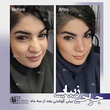 جراحی بینی گوشتی