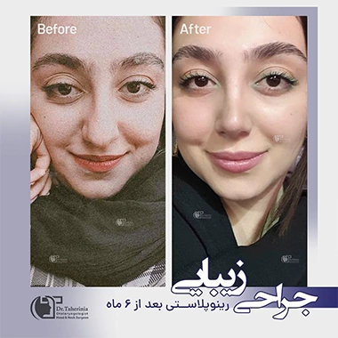عمل بینی گوشتی