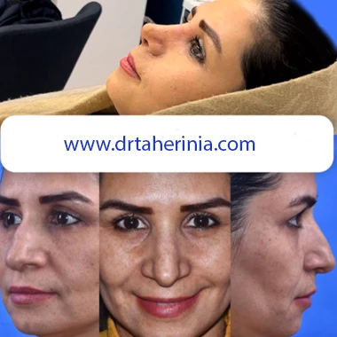 نمونه کار جراحی بینی گوشتی دکتر طاهری نیا