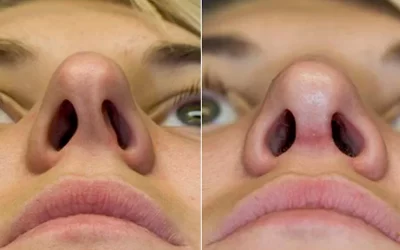 جراحی بینی کج با بهترین نتیجه + نمونه کار