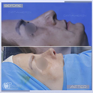 عکس جراحی ترمیمی بینی