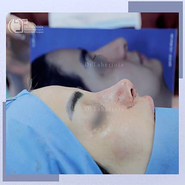 نمونه کار جراحی بینی ترمیمی