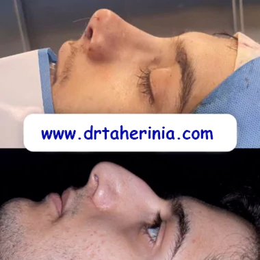 نمونه کار بهترین جراح بینی استخوانی
