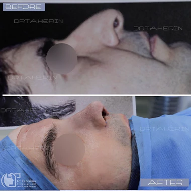 نمونه کار دکتر طاهری نیا بهترین جراح بینی استخوانی