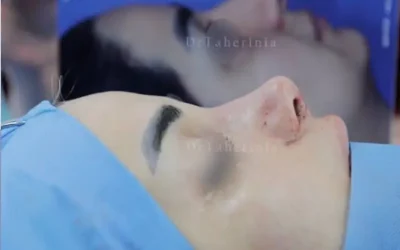 جراحی زیبایی بینی؛ راهنمای جامع برای زیبایی و تناسب صورت